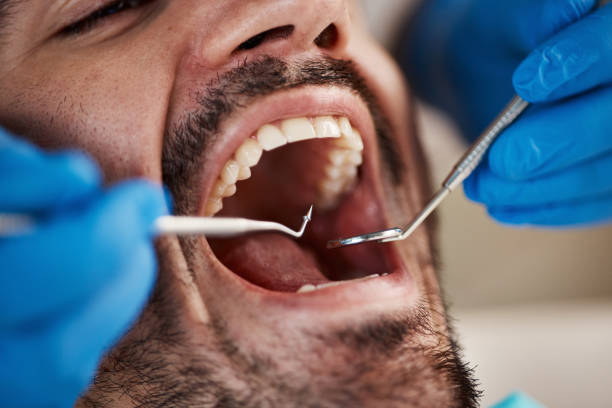 Best Emergency Tooth Extraction in Barneveld, WI